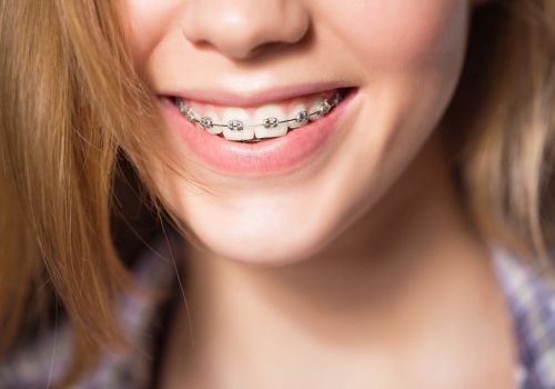 Những điều bạn cần biết trước và sau khi niềng răng