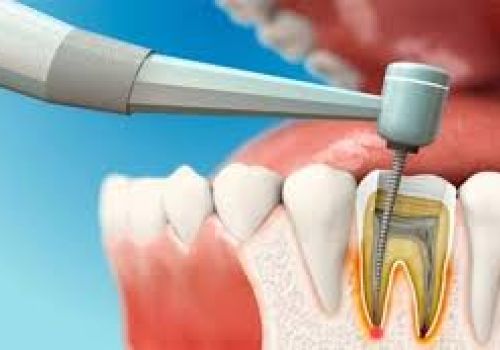Cấy tủy răng nhân tạo - giải pháp hiện đại cho vấn đề răng miệng