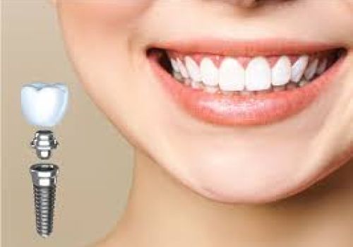 Cấy ghép răng Implant- Giải pháp khôi phục răng hiệu quả