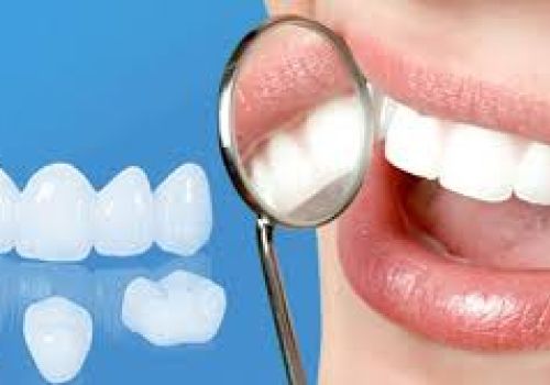 Có nên bọc răng sứ không? Những trường hợp nên bọc răng sứ