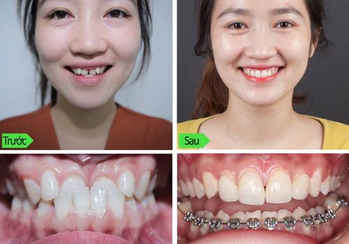 Niềng răng cho bé gái 11 tuổi