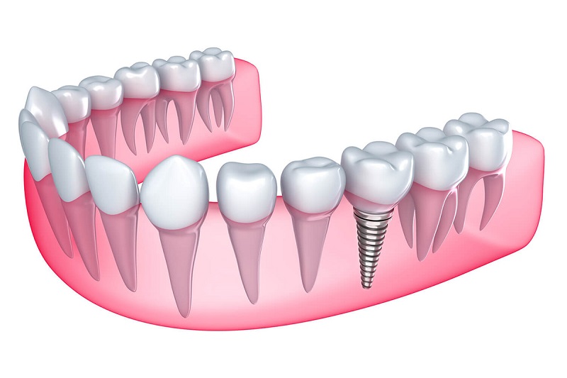 20220427_cay-ghep-Implant-la-gi